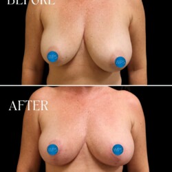 patient was bothered by her low nipple position and lack of breast shape/definition - Dr. Glener performed a breast lift - correcting the nipple position, and restoring a more youthful shape to the breast. patient was bothered by her low nipple position and lack of breast shape/definition - Dr. Glener performed a breast lift - correcting the nipple position, and restoring a more youthful shape to the breast.