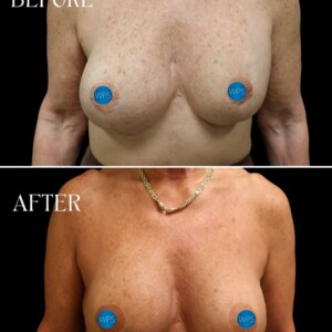 Breast implant exchange by Dr. Glener 3 months post op Breast implant exchange by Dr. Glener at Wilmington Plastic Surgery & Med Spa 3 months post op