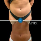 Liposuction pictured 2 months post op by Dr. Glener Liposuction pictured 2 months post op by Dr. Glener at Wilmington Plastic Surgery & Med Spa