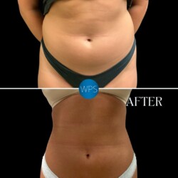 Liposuction pictured 2 months post op by Dr. Glener Liposuction pictured 2 months post op by Dr. Glener at Wilmington Plastic Surgery & Med Spa