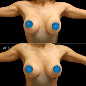 Dr. Glener performed an implant exchange, capsulectomy (removal of scar tissue) and an inferior wedge Mastopexy (breast lift). Dr. Glener performed an implant exchange, capsulectomy (removal of scar tissue) and an inferior wedge Mastopexy (breast lift).