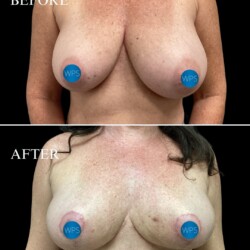 Bilateral mastopexy (breast lift) pictured 5 weeks post-op Bilateral mastopexy (breast lift) pictured 5 weeks post-op