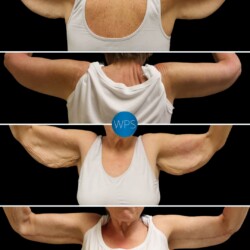 This beautiful patient was bothered by the excess skin in her upper arms after weight loss. Dr. Glener addressed her concerns with a Brachioplasty, resulting in an enhanced but natural contour. 💪
•
Scar placement in Brachioplasty is critical. Dr. Glener intentionally places the scar on the inside of the arm, so it is concealed unless intentionally revealed. Dr. Glener addressed her concerns with a Brachioplasty, resulting in an enhanced but natural contour.