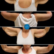 This beautiful patient was bothered by the excess skin in her upper arms after weight loss. Dr. Glener addressed her concerns with a Brachioplasty, resulting in an enhanced but natural contour. 💪
•
Scar placement in Brachioplasty is critical. Dr. Glener intentionally places the scar on the inside of the arm, so it is concealed unless intentionally revealed. Dr. Glener addressed her concerns with a Brachioplasty, resulting in an enhanced but natural contour.