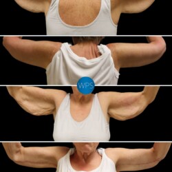 This beautiful patient was bothered by the excess skin in her upper arms after weight loss. Dr. Glener addressed her concerns with a Brachioplasty, resulting in an enhanced but natural contour. 💪
•
Scar placement in Brachioplasty is critical. Dr. Glener intentionally places the scar on the inside of the arm, so it is concealed unless intentionally revealed. Dr. Glener addressed her concerns with a Brachioplasty, resulting in an enhanced but natural contour.