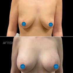Breast Augmentation part 1 by Dr. Glener Breast Augmentation part 1 by Dr. Glener