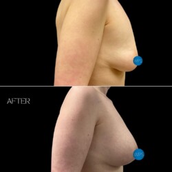 Breast Augmentation part 2 by Dr. Glener Breast Augmentation part 2 by Dr. Glener