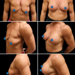 Bilateral augmentation with lift using motiva implants by Dr. Glener. Pictured 5 months post-op Bilateral augmentation with lift using motiva implants by Dr. Glener at Wilmington Plastic Surgery & Med Spa. Pictured 5 months post-op