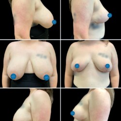 Bilateral implant removal with breast lift - galaflex. Pictured 6 months post op by Dr. Glener Bilateral implant removal with breast lift - galaflex. Pictured 6 months post op by Dr. Glener at Wilmington Plastic Surgery & Med Spa