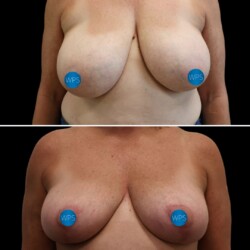 Breast reduction pictured 3 months post op by Dr. Glener Part 1. Breast reduction pictured 3 months post op by Dr. Glener Part 1.