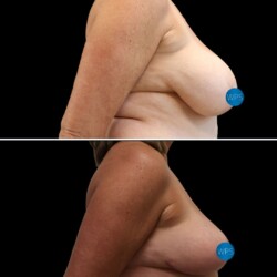 Breast reduction pictured 3 months post op by Dr. Glener Part 3 Breast reduction pictured 3 months post op by Dr. Glener Part 3