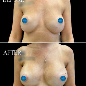 Breast implant exchange pictured 3 months post-op by Dr. Glener Breast implant exchange pictured 3 months post-op by Dr. Glener