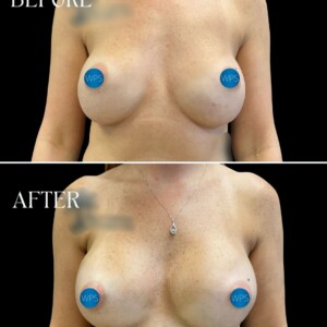 Breast implant exchange pictured 3 months post-op by Dr. Glener Breast implant exchange pictured 3 months post-op by Dr. Glener