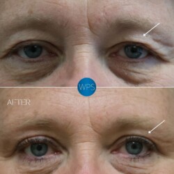 Surgical eyelid procedure, blepharoplasty. Part 1 pictured 4 months post-op by Dr. Glener Surgical eyelid procedure, blepharoplasty. Part 1 pictured 4 months post-op by Dr. Glener