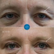 Surgical eyelid procedure, blepharoplasty. Part 1 pictured 4 months post-op by Dr. Glener Surgical eyelid procedure, blepharoplasty. Part 1 pictured 4 months post-op by Dr. Glener