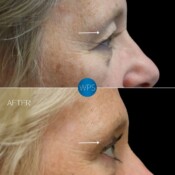 Surgical eyelid procedure, blepharoplasty. Part 2 pictured 4 months post-op by Dr. Glener Surgical eyelid procedure, blepharoplasty. Part 2 pictured 4 months post-op by Dr. Glener