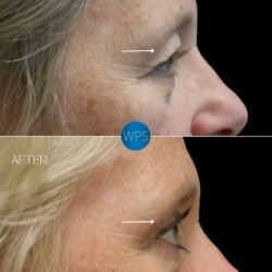 Surgical eyelid procedure, blepharoplasty. Part 2 pictured 4 months post-op by Dr. Glener Surgical eyelid procedure, blepharoplasty. Part 2 pictured 4 months post-op by Dr. Glener