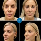 This patient underwent selective facial fat grafting to restore volume in key areas of the face — a subtle yet powerful way to address facial aging. To amplify her results, we combined it with non-surgical rejuvenation using BBL and HALO lasers, a chemical peel, and a customized medical-grade skincare regimen at our medical spa. This patient underwent selective facial fat grafting to restore volume in key areas of the face — a subtle yet powerful way to address facial aging. To amplify her results, we combined it with non-surgical rejuvenation using BBL and HALO lasers, a chemical peel, and a customized medical-grade skincare regimen at our medical spa.