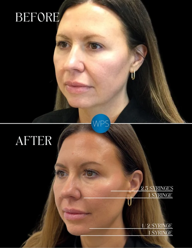 Have you ever wondered what a full facial rejuvenation treatment using 5 syringes of dermal filler looks like? This! ✨✨✨
•
This patient was looking for restoration after a significant weight loss. By strategically adding volume back to certain areas of the face we achieved a more youthful and lift for this patient😍
•
Schedule an appointment to save on multiple syringes with Summer Specials! 

💉 Buy 2 syringes of filler, get the 3rd syringe half off (up to $400 savings)
💉 Buy 3 syringes of filler, get the 4th syringe half off + a free Skinvive treatment & HA5 sampler (up to $760 savings)
•
☎️ 910-509-7546 #wps #wpsmedspa #wilmingtonplasticsurgery #dermalfiller #filler #injector #injectables #medspa #medicalspa #wilmingtonnc
